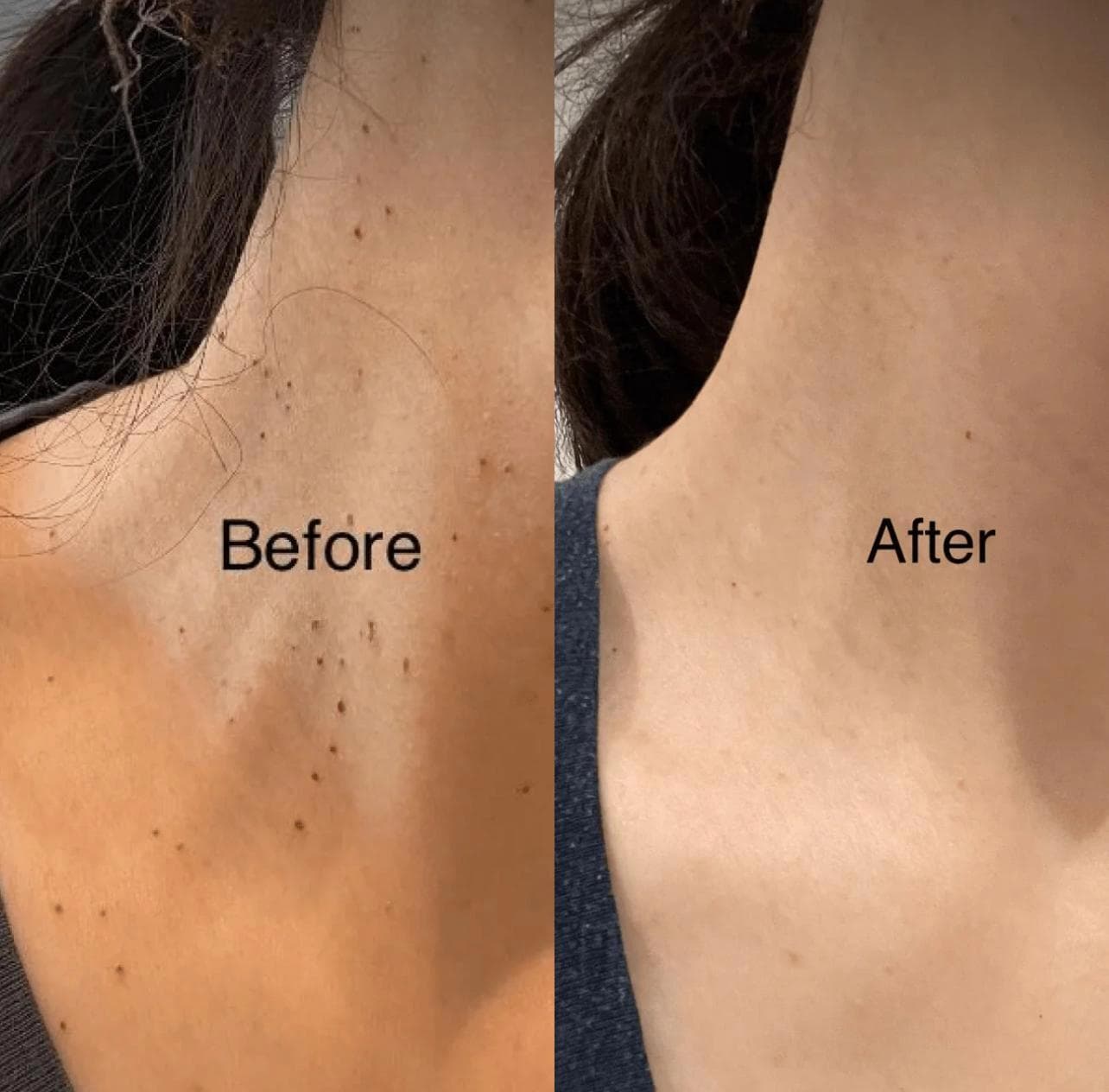 Tag Skin Removal Treatment