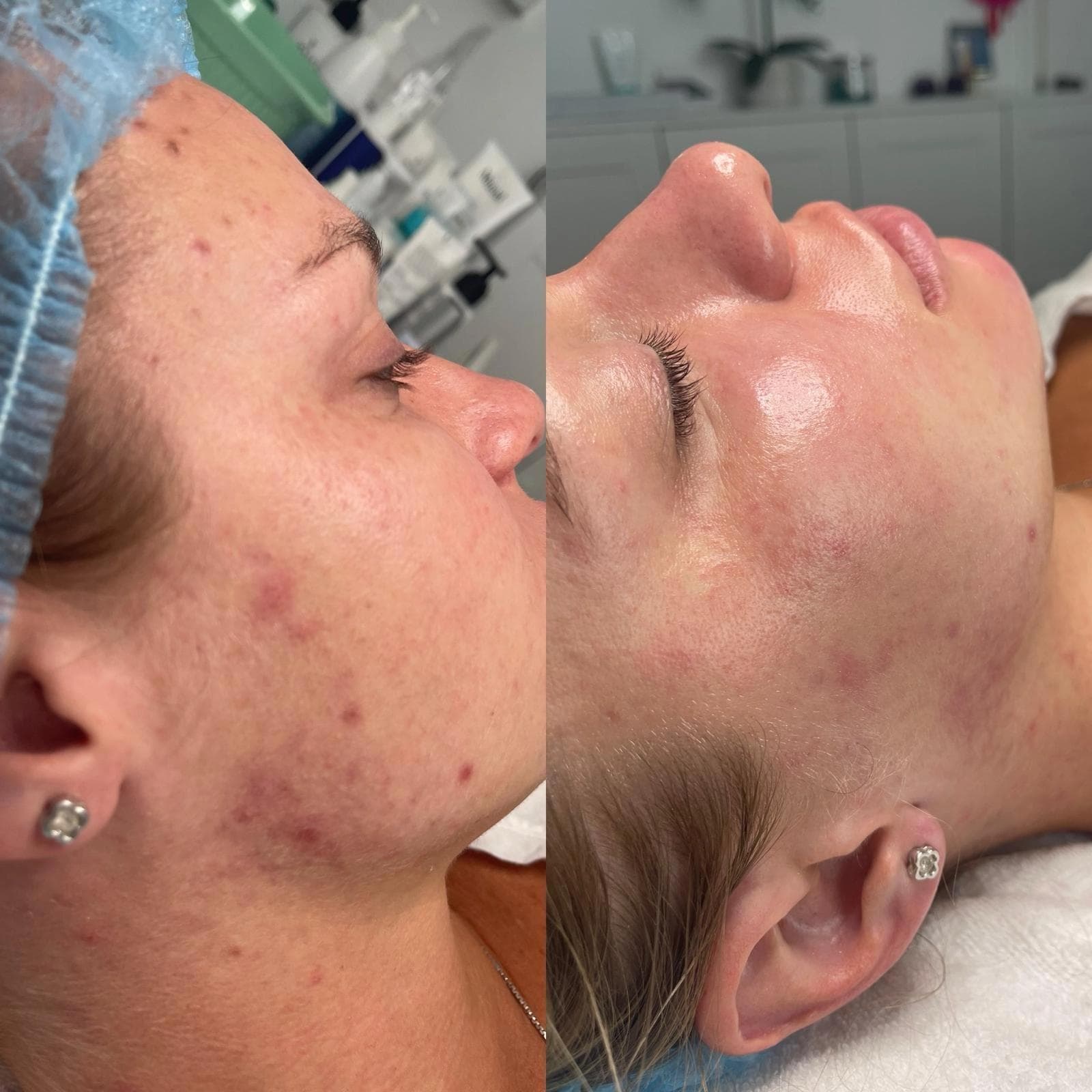 Acne Clearing Facial Therapy